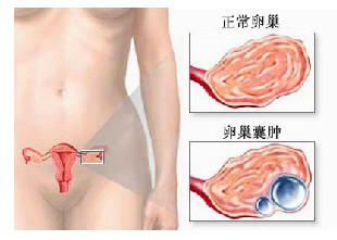 卵巢囊肿2.jpg